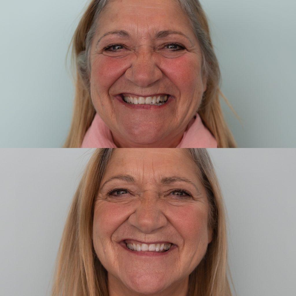 Whitening Lynne Before and After